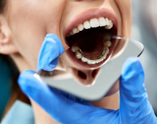 lingual-braces-kantos lingual-braces-kantos