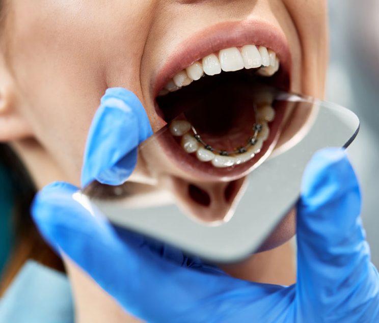 lingual-braces-kantos